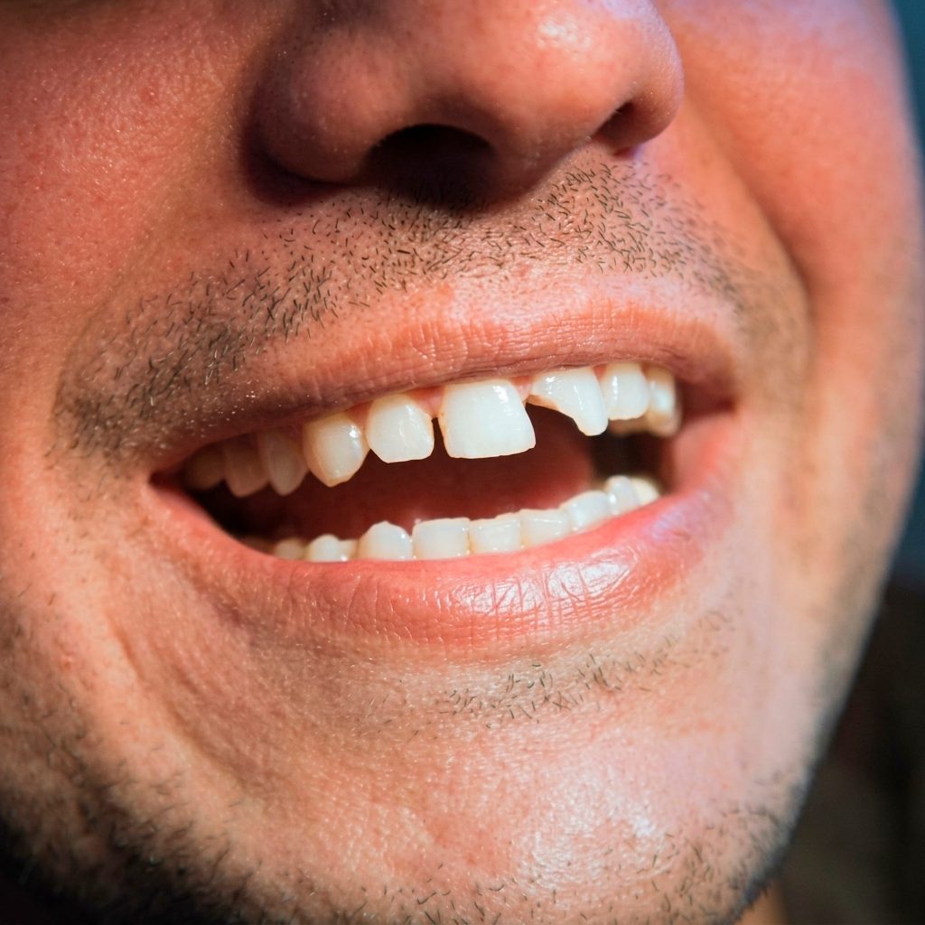 Dente quebrado
